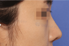 韩国梦想整形医院案例公开，含眼鼻脂肪填充手术前后图片