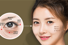 韩国will整形眼修复多少钱？单纯双眼皮修复大概220万韩币！