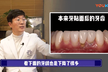 牙贴面会伤害牙龈吗 韩国出名minish牙科医生视频做专业解答