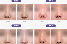 韩国绮林整形鼻子修复怎么样 做鼻修复会不会留下明显疤痕