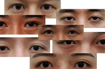 韩国双眼皮改单真实图片 原有和手术后双眼皮想改都能改