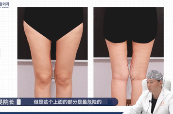 韩国VG百利酷整形揭秘大腿过量吸脂反而更难看！