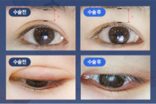 看韩国iou整形外科修复双眼皮前后图！不愧是眼修复排行榜医院！