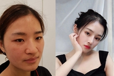 韩国哪家医院可以做鼻头缩小？术后会出现疤痕增生吗？