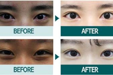 韩国伊美芝和soonplus哪家医院做开眼角手术疤痕处理更自然？