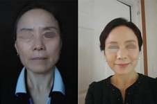 韩国ID童颜迷你拉皮手术改善下垂有奇效！紧致v脸不是梦！