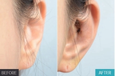 贴发耳手术哪里能做？做完贴发耳矫正术后会反弹是真的吗?