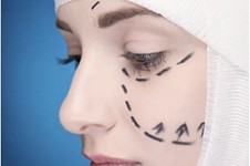 面部拉皮手术适合多大年龄的人？做完能维持多久？