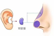 耳软骨隆鼻半年基本没了，重新修复一定要注意这些问题！