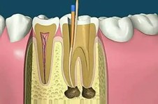 自己把牙髓吸出来了，医生辟谣说这多半是心理作用！