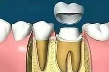 韩国登腾牙冠好不好？一篇看懂全瓷牙冠优缺点和价格！