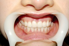 南宁牙齿矫正医院排名公开，看看哪里做牙套比较好！