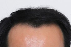 韩国佰诺佰琪整形医院毛发移植怎么样 男女方案设计有区别