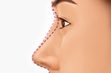 韩国佰诺佰琪整形医院鼻部整形有经验 参照个人情况了解！