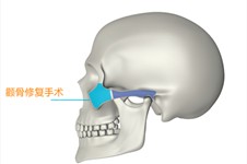 颧骨修复手术用什么材料做的 韩国H整形外科医院深度剖析