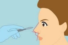 韩国VG百利酷整形医院鼻修复手术怎么样 可圈可点优势公布