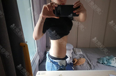 韩国抽腰腹脂肪的真人案例，经历痛苦3周减围20cm！