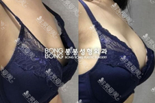 韩国bongbong棒棒整形医院假体隆胸手术效果好吗？案例如何？