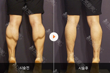 韩国hafis医院吸脂腿部图片分享，吸脂这几个优势值得看！