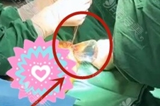 隆胸假体要使劲塞进去吗？视频揭秘韩国手术塞假体都用它