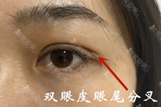 双眼皮术后分叉原因是什么能长好吗?韩国眼尾分叉怎么修复