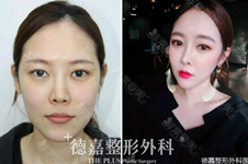 韩国郑载用鼻修复技术怎么样？听说鼻修复很自然是真的吗