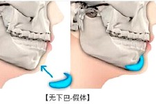 臺(tái)州維多利亞做假體墊下巴整形怎么樣，深挖優(yōu)勢(shì)好處