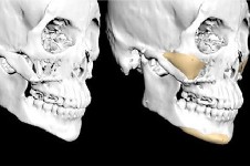 杭州时光：3D打印人造骨骼技术成熟，多应用于轮廓修复！