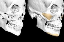 杭州時光：3D打印人造骨骼技術成熟，多應用于輪廓修復！