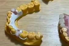 儿童牙支架多少钱一个？牙齿支架价格在500~8000元左右