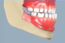 成人反颌的矫正方法有哪些？明确成人牙齿反颌都怎么矫正