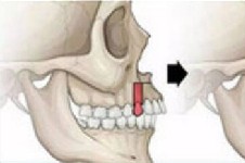 上颌骨截骨手术过程解析,看后秒懂上颌骨矫正手术是怎么做