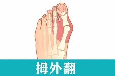 天生大腳骨可以矯正嗎？別不信，大腳骨真的能矯正過來