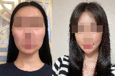 韩国1%面部吸脂轮廓整形日记，含术后半年真实恢复过程图