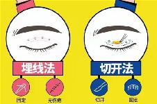 韩国自然粘连法双眼皮和埋线双眼皮区别是什么？