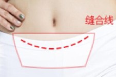 韩国肚皮整形哪里可以做？欧佩拉竟有2种腹部整形手术方式