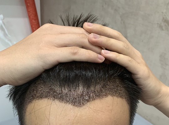 发际线种植的真实经历，上海艺星微针植发拒绝二次损伤