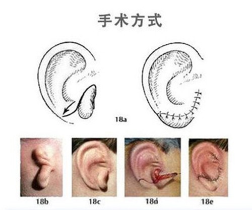 精灵耳整形手术怎么矫正?河南中医院耳朵整形项目有哪些?