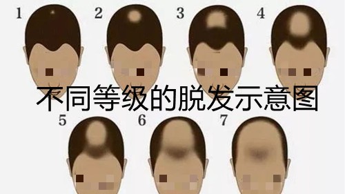 本身发量少怎么植发？植发发源、发量不够如何植发？