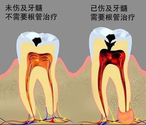 宁愿虫牙继续蛀也不愿意补牙?牙医违背祖训透露不补多可怕