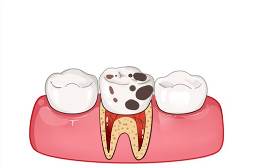 惊闻根管治疗骗局，有蛀牙问题牙医补牙故意钻到牙髓？