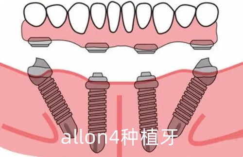 allon4种植牙详细步骤！哈尔滨市种植牙医院圣琪口腔好吗？