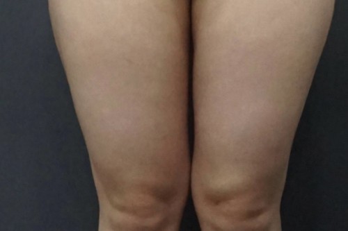 大腿吸脂手术多久可以恢复？韩国Qine医院大腿吸脂第二天！