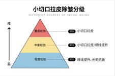 2021国内拉皮手术费用是多少！小切口拉皮全脸提升效果如何