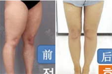 帮你吸出“小鸟腿”的韩国医院科普：劳波儿365吸脂247整形