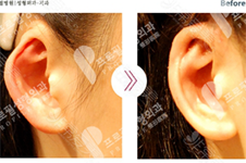 耳软骨隆鼻导致耳轮凹陷该如何修复？韩国哪家医院能做？