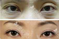 韩国bio医院曹仁昌、辛容镐做眼睛谁更好?眼睛修复该选谁?