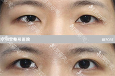 韩国初雪chutnoon整形医院双眼皮修复日记分享