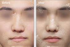 唇裂鼻畸形鼻孔可以矫正吗？韩国哪些整形医院能修复鼻孔?