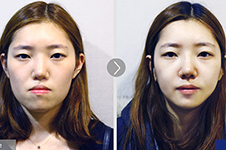 韩国凸嘴手术多少钱?凸嘴手术哪里做好?前后对比照片曝光！
